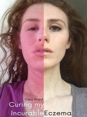 cover image of Curing my Incurable Eczema